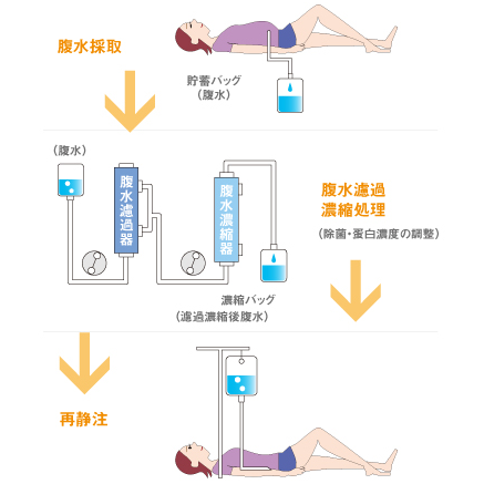 腹水濾過濃縮再静注法（CART）概要