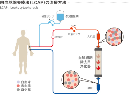 LCAP療法の方法
